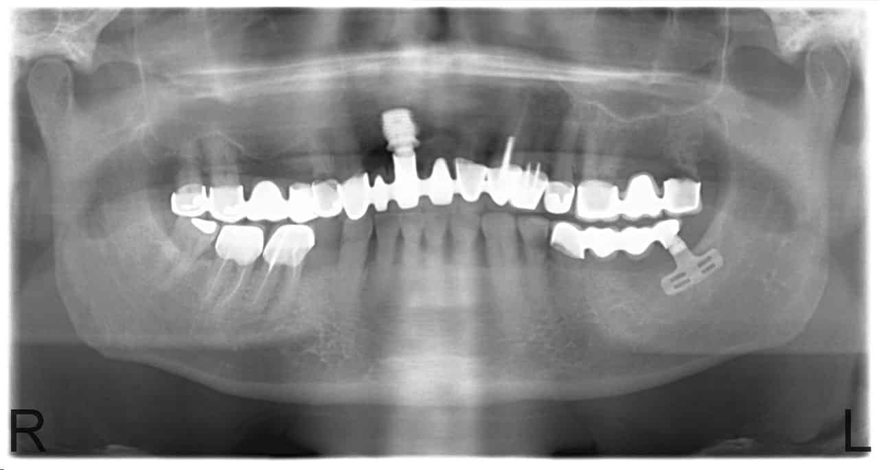 implantátum Budapest